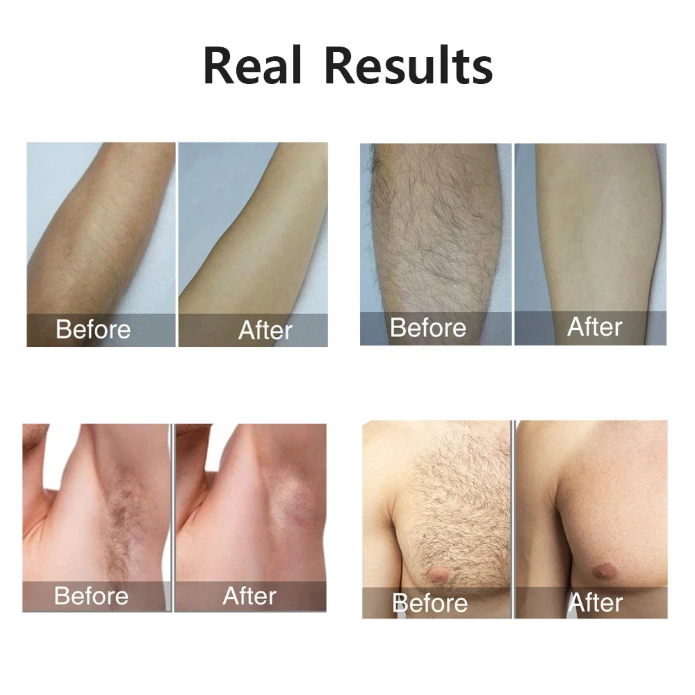HOMEFISH Laser Epilator IPL Hair Removal For Women Body Bikini Facial 990000 Flashes Permanant Painless IPL Hair Remover Laser